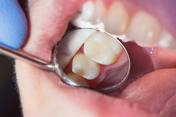 What Are Composite Fillings?
