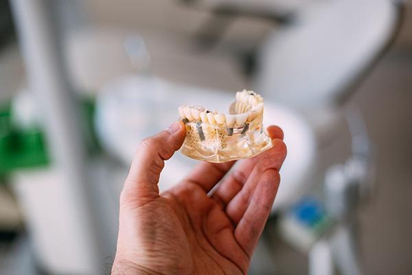 What are All-On-X Implants?