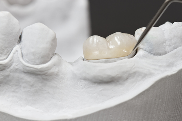 What Are Porcelain Inlays & Onlays?